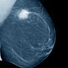 mammogram_xray_cancer_270w