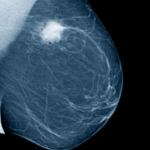 What is a Mammogram & How Does It Detect Breast Cancer?