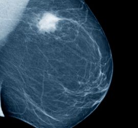 6 Symptoms of Breast Cancer