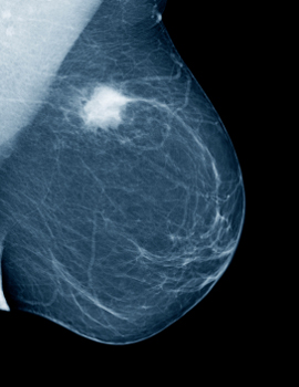 mammogram_xray_cancer_270w